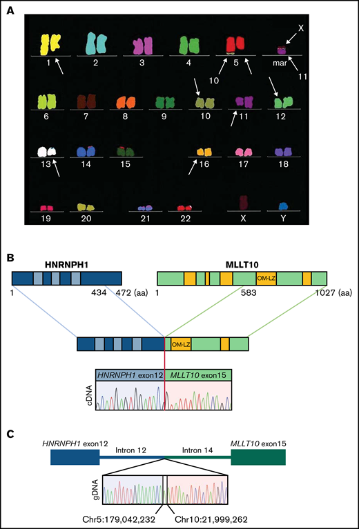 Molecular characterization of the HNRNPH1-MLLT10 fusion. (A) Multicolor fluorescence in situ hybridization indicating a complex karyotype including del(5q). (B) HNRNPH1-MLLT10 splicing isoform identified in the present case is shown. GenBank accession numbers referred to are NM_001364227.2 for HNRNPH1 and NM_004641.4 for MLLT10. Hypothetical fusion protein is shown in which HNRNPH1 maintained all 3 RNA-recognition motifs at the N-terminus and MLLT10 maintained the critical OM-LZ domain at the C-terminus. Sanger sequencing of complementary DNA revealed that exon 10 of HNRNPH1 (rather than exon 12, which was reported previously) fused in frame with exon 15 of MLLT10 (as reported previously). (C) Sanger sequencing indicates genomic breakpoints at position Chr5:179 042,232 within HNRNPH1 gene and Chr10: 21 999,262 in MLLT10 gene with a single nucleotide insertion.