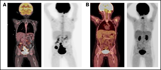 PET scan response before and after blinatumomab treatment. (A) PET scan on day +92 showing concern for PTLD with multifocal, fluorodeoxyglucose-avid uptake and lymphadenopathy in the abdomen and pelvis. (B) PET scan on day +179 showing significant metabolic and structural improvement of abdominal and pelvic lesions 1 day after completion of blinatumomab. PET, positron emission technology; PTLD, posttransplant lymphoproliferative disease.