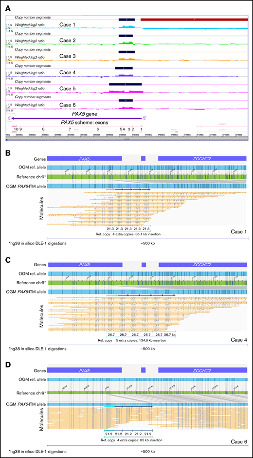 PAX5-ITM characterization by CMA and OGM. (A) A screenshot from the Chromosome Analysis Suite (ChAS) CMA analysis software showing copy number gains in the 5′ portion of the PAX5 gene in the 6 PAX5-ITM+ cases (dark blue bars on the Copy Number Segments plots). OGM characterization of PAX5-ITM: case 1, showing 4 extra copies of the affected region in direct orientation, each ∼21 kb in size (B); case 4, showing 5 extra copies of the multiplied region in direct orientation, each ∼26 kb in size (C); and case 6, showing 4 extra copies of the affected region in direct orientation, each ∼21 kb in size (D). Arrows indicate copies of the multiplied region in the Bionano long-molecule assembly for the mutant allele, as compared with the chromosome 9 map (green) and the assembly from reference samples (top, light blue bar). Additional copies of the affected region are also visible in individual long molecules (yellow lines).
