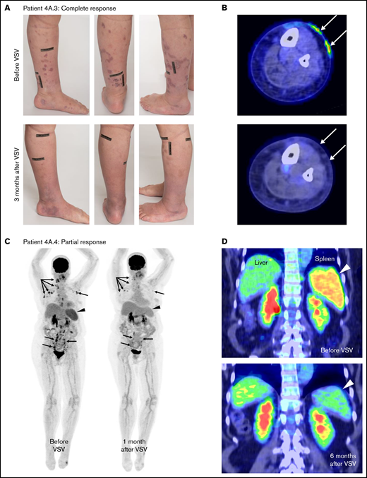 A single dose of VSV-IFNβ-NIS monotherapy has clinical activity in patients with TCL. Photographs (A) and PET/CT scans (B) showing resolution of FDG-avid lesions of patient 4A.3 with TCL with cutaneous relapse of nodal PTCL who achieved a CR after receiving 1 dose of VSV-IFNβ-NIS at DL4. (C) FDG PET images of patient 4A.4 with nodal PTCL showing remarkable improvement in FDG-avid cervical, mediastinal, axillary, and abdominal lymph node disease (arrows) with decreased splenic size and FDG uptake (arrowheads) at 1 month. (D) Coronal fused FDG PET/CT images demonstrate improvement in splenic disease (arrowheads), with continued response in the spleen at the 6-month evaluation.