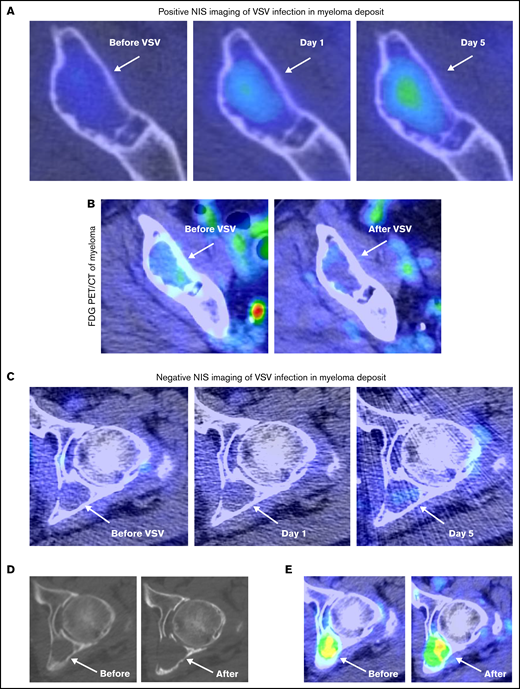 Positive NIS imaging of virus-infected tumor corresponded with reduction in FDG avidity. (A) In patient 3A.1 with multiple myeloma, axial fused 99mTc-pertechnetate SPECT/CT images demonstrate increasing uptake within a lytic lesion in the anterior right ilium (arrows) on comparison at baseline before VSV, day 1 (24 hours), and day 5 images (arrows). (B) This same lesion demonstrated decreased FDG activity when comparing pre- and posttherapy PET/CT images (arrows). (C) In contrast, a left acetabular lesion in the same patient demonstrated no increased uptake on SPECT/CT at baseline, day 1, or day 5 scans, suggesting minimal VSV infection (arrows). The 6-month follow-up CT (D) and fused PET/CT images (E) showed progression of the acetabular lesion, with increased size, bone destruction, and FDG uptake (arrows).