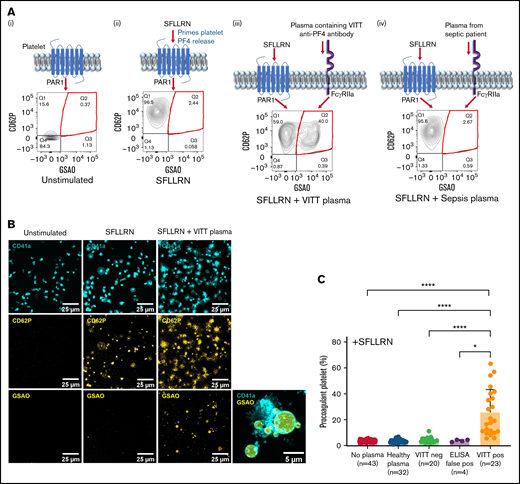 Plasma from patients with VITT sensitizes healthy donor platelets to become procoagulant. (A) Schematic diagram and representative flow cytometry plots depicting platelet P-selectin expression (CD62P) and GSAO uptake on (i) unstimulated donor platelets and upon stimulation with (ii) 5 µM SFLLRN alone or (iii) a synergistic combination of SFLLRN and plasma containing VITT anti-PF4 antibodies or (iv) plasma from a patient with bacterial sepsis. PPs are defined as GSAO+/CD62P+ platelet events (red quadrant). (B) Confocal imaging of healthy donor platelet-rich plasma exposed to 5 µM SFLLRN alone or SFLLRN and VITT plasma. Platelets are identified by CD41a antibody (cyan, top panel), whereas P-selectin (CD62P in yellow, middle panel) marks activated platelets. GSAO uptake is shown in yellow (bottom panel). PPs are characterized by ballooning morphology and GSAO uptake (bottom right panel). (C) PP flow cytometry was performed by using healthy donor whole blood treated with platelet agonist 5 µM SFLLRN (n = 43) and incubated with plasma from healthy individuals (n = 32), ChAdOx1 nCoV-19–vaccinated patients with thrombocytopenia and thrombosis but without detectable anti-PF4 antibodies (VITT neg, n = 20), vaccinated patients who were not thrombocytopenic with detectable anti-PF4 antibodies (ELISA false pos, n = 4), or clinically confirmed SRA-positive VITT patients with thrombocytopenia, thrombosis, and detectable anti-PF4 antibodies (VITT pos, n = 23). PP percentages were defined by the proportion of GSAO+/CD62P+ platelet events. Kruskal-Wallis test with Dunn’s correction for multiple comparisons was performed. Error bars indicate mean ± standard deviation. *P < .05, ****P < .0001.