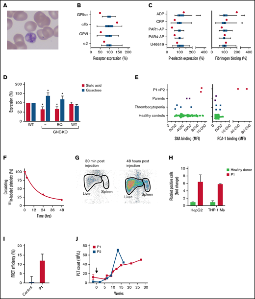 The 420Q-GNE variant is associated with platelet hyposialylation and enhanced hepatic clearance. (A) Peripheral blood smear of P1. (B) Relative expression of the glycoprotein Ib-V-IX complex (GPIbα), fibrinogen receptor αIIbβ3 (αIIb), and collagen receptors glycoprotein VI (GPVI) and α2β1 (α2) in P1 (red dots) and 49 healthy controls measured with flow cytometry. Data of healthy controls (green) are expressed in box and whiskers. Average median fluorescent intensity values in controls were set at 100%. Whiskers represent 2.5th and 97.5th percentiles. (C) Platelet reactivity measured with flow cytometry in P1 (red dot) and 49 healthy controls (green box and whiskers). Platelets were stimulated with 60 μM ADP, 25 μM protease-activated receptor (PAR)-1 activating peptide (PAR1-AP) SFLLRN, 250 μM PAR4-AP AYPGKV, 1 μg/mL cross-linked collagen-related peptide (CRP-XL), or 5 μM U-46619, fixated and analyzed for expression of P-selectin as marker for granule secretion and fibrinogen binding as marker for αIIbβ3 activation. Average median fluorescent intensity values in controls were set at 100%. Whiskers represent 2.5th and 97.5th percentiles. (D) Wild-type (WT), GNE-deficient (KO), and GNE-deficient HEK293 cells overexpressing either recombinant WT-GNE, or recombinant 420Q-GNE (RQ) were incubated with fluorescein-conjugated SNA lectin for analysis of sialic acid expression, or fluorescein-conjugated RCA-1 lectin for analysis of galactose expression. Lectin binding was assessed with flow cytometry. Data were normalized on lectin binding in WT HEK293 cells (n = 3). *P < .05, error bars represent the standard deviation. (E) Platelet sialic acid exposure was measured with fluorescein-SNA lectin and galactose exposure was measured with fluorescein-RCA-1 lectin on a flow cytometer in both P1 and P2, their parents, 4 thrombocytopenic patients, and 68 healthy controls. MFI, median fluorescent intensity. (F) Autologous platelets were labeled with 111In-tropolone and injected into P1. Platelets were collected at different time points to determine platelet half-life. The fraction 111In-labeled platelets at 30 minutes after injection was set at 100%. Data represent the relative proportion of 111In-labeled platelets at each time point. (G) Anterior static single-photon emission computed tomography scans of the abdomen of P1 were made with a Symbia T2 γ camera (Siemens, Erlangen, Germany) at indicated time points to quantify platelet sequestration. Radioactivity in liver and spleen regions (thick black lines) was assessed as the percentage of total radioactivity. Spleen:liver radioactivity ratio <0.8 indicates hepatic sequestration. (H) Celltracker Deep Red-labeled platelets of P1 (red) (n = 2) and healthy controls (green) were incubated with THP-1 macrophages (n = 4) and HepG2 hepatocytes (n = 3). Data are normalized on the number of platelet-binding cells with control platelets. (I) Platelets from P1 (red) (n = 3) or healthy controls (green) (n = 3) were labeled with fluorophore conjugated anti-GPIbα Fab′-fragments (6B4). Fluorophore lifetime in presence and absence of an acceptor was assessed and used to calculate fluorescence resonance energy transfer efficiency. (J) Change in platelet count in P1 and P2 after initiation of treatment with romiplostim (black arrow).