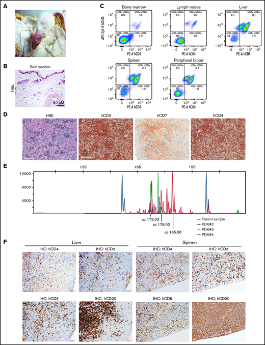 Transplanted SS cells reproduce the human disease in mice. (A) Representative photograph of a mouse at 8 weeks after being transplanted with 2 million SS cells. (B) Hematoxylin and eosin (H&E) staining of a skin section of the same animal obtained at euthanasia. (C) FC analysis of the different organoids indicated the presence of SS infiltrates. (D) IHC analysis of liver sections to confirm FC data. (E) Clonality analysis by PCR analysis of SS from patient #23 and blood from 2 different mice transplanted with SS cells from the same patient. (F) IHC of the liver and spleen of a representative mouse transplanted with cells from patient #23. Note the high amounts of aberrant CD20+ B cells, already present in the patient, that infiltrate the organs in addition to the CD3+;CD4+;CD5+ SS population.