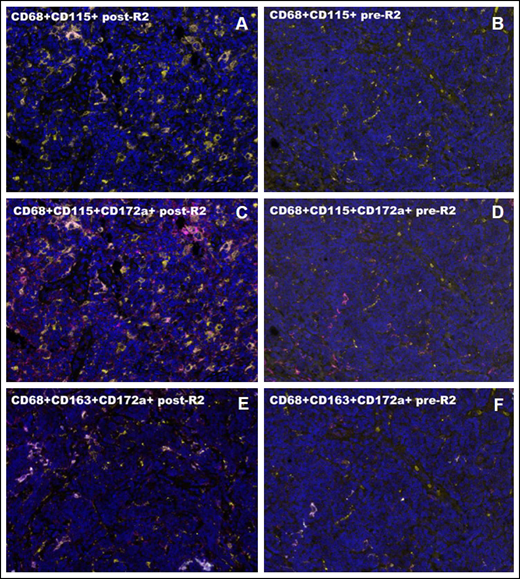 Macrophage characterization by multiplex immunofluorescence. (A-B) CD68+CD115+ cells after and before R2. (C-D) CD68+CD115+CD172a+ cells after and before R2. (E-F) CD68+CD163+CD172a+ cells after and before R2. High magnification areas (40×) are shown for all cases. Intrapatient comparisons are reported. In panel A, the post-R2 FL sample shows a high concentration of CD68+CD115+ cell population (CD68, yellow; CD115, pink). In panel B, the pre-R2 FL sample shows a lower concentration of CD68+CD115+ cell population (CD68, yellow; CD115, pink). In panel C, the post-R2 FL sample shows a high concentration of CD68+CD115+CD172a+ cell population (CD68, yellow; CD115, pink; CD172a/SIRPα, magenta). In panel D, the pre-R2 FL sample shows a lower concentration of CD68+CD115+CD172a+ cell population (CD68, yellow; CD115, pink; CD172a/SIRPα, magenta). In panel E, the post-R2 FL sample shows a high concentration of CD68+CD163+CD172a+ cell population (CD68, yellow; CD163, cyan; CD172a/SIRPα, magenta). In panel F, pre-R2 FL sample shows A lower concentration of CD68+CD163+CD172a+ cell population (CD68, yellow; CD163, cyan; CD172a/SIRPα, magenta).