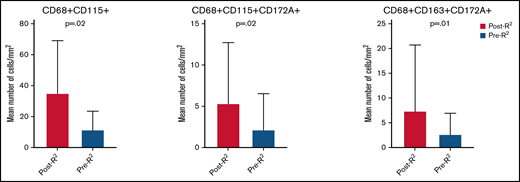Tissue macrophage populations increased at time of progression after frontline R2 in patients with FL. Only populations whose association was maintained on multivariate analysis are shown in the graphic.