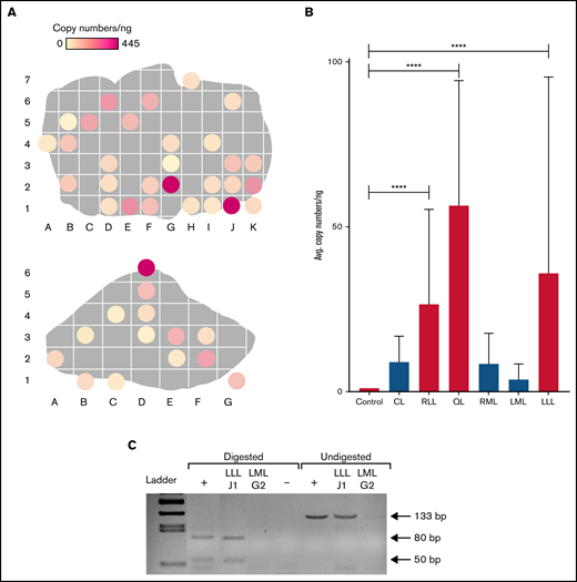 Distribution of plasmid in FLR004 liver tissue. (A) Distribution maps show plasmid copy numbers per nanogram in transfected FLR004 liver lobes, which were sectioned according to an alphanumerical grid upon necropsy. The top panel shows the LLL, and the bottom panel shows the RLL. Lighter colors indicate lower copy number, and darker colors indicate higher copy number up to 445 copies per nanogram in the LLL. (B) A summary graph demonstrates comparison of average plasmid copy number per nanogram of genomic DNA among all FLR004 lobes and the untreated canine control. The caudate lobe (CL) (n = 7), RLL (n = 14), quadrate lobe (QL) (n = 4), right medial lobe (RML) (n = 10), left medial lobe (LML) (n = 8), and LLL (n = 29) are shown. Treated lobes are shown in black, and untreated lobes are shown in gray. (C) The PCR fragment amplified from genomic DNA samples isolated from a treated lobe (LLLJ1) and an untreated lobe (LMLG2) were either undigested or digested with ApaLI and analyzed by using agarose gel electrophoresis. Digestion of the expected PCR fragment (133 bp) produced 2 fragments ∼50 bp and 80 bp long. Plasmid diluted in canine genomic DNA undigested or digested with ApaLI was used as the positive control (+), and nuclease-free water digested was used as the negative control. Error bars indicate standard deviation. ****P < .0001.
