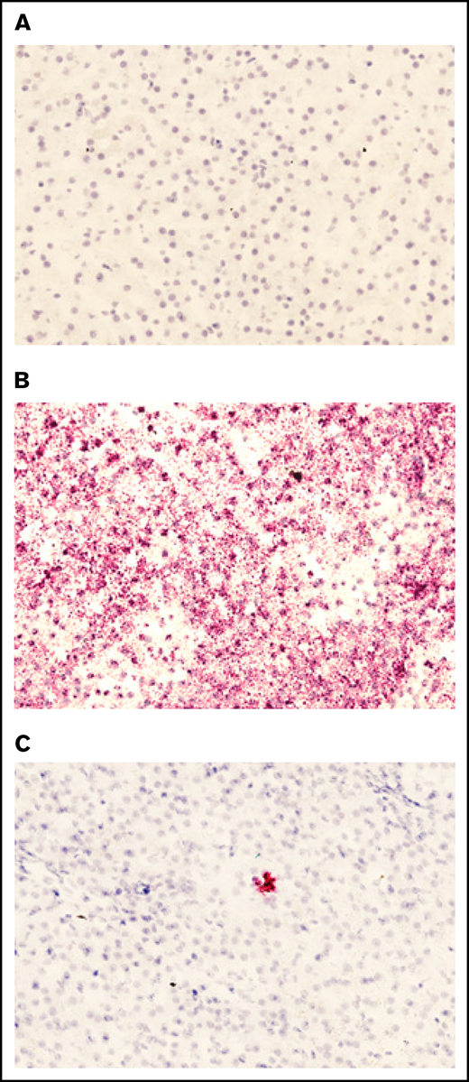 Presence of pHP-hF8-X10 mRNA in treated canine liver tissue. (A) Tissue sections stained with a negative control probe showed no signal, indicating that there was no nonspecific staining. (B) Tissue stained with a positive control probe, which binds a highly expressed canine mRNA sequence, showed widespread staining. (C) Tissue was stained with a probe that specifically binds FVIII mRNA. Red dots indicate the presence of either (B) positive control mRNA or (C) pLP-hF8-X10 mRNA in canine liver tissue collected upon necropsy at 60 days after surgery. Liver was cut into 1-cm squares and frozen in optimal cutting medium, then sectioned at 7 microns and subjected to the RNAscope 2.5 HD – Red Assay. Sections were also stained with hematoxylin to show tissue morphology. Each red dot indicates the presence of 1 copy of pHP-hF8-X10 mRNA in experimental canine tissue. All sections shown are representative selections from the RLL of FLR004, section D6.