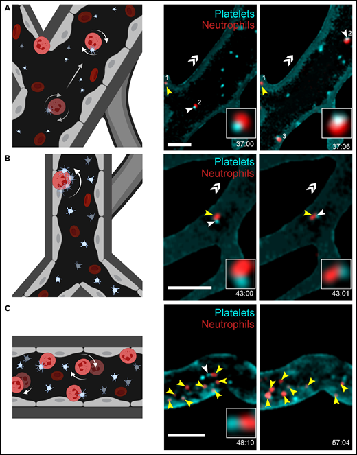 Platelet and neutrophil interactions observed in response to immune complexes. (A-C) Schematic representations (left panels) of different cellular interactions recorded in the brain of both FcγRIIATGN and FcγRIIAnull (Ly6gCre+/−::Rosa26-TdT+/−::CD41-YFP+/−) mice injected with immune complexes and observed with a high-speed widefield fluorescence microscope (right panels). (A) Platelet (cyan) and neutrophil (red) interactions can be associated with partial adhesion (rolling) of neutrophils (neutrophil 2) on blood vessels. (B) “Kiss and fly interaction,” in which an adhered neutrophil (red) briefly interacts with circulating platelets (cyan). (C) Neutrophils (red) adhere to blood vessels in response to immune complexes. Circulating platelets (cyan) interact (white arrows) with both immobilized and rolling neutrophils (yellow arrows). Bars represent 50 µm. The direction of blood flow is indicated with double white arrow heads. Time following the injection of immune complexes is indicated in the inferior right corner (00:00 = minutes:seconds or 00:00:00 = hours:minutes:seconds). Rolling and adhered neutrophils are indicated with yellow arrows, and neutrophil–platelet interactions are indicated with white arrows. (D) Schematic representation of the computer analysis used to track neutrophil trajectories and speed: (1) Image stabilization using Mathworks Matlab 2018b; (2) Neutrophil tracking performed with Bitplane Imaris 7.6 software; (3-4) Automated classification of trajectories using a program in Mathworks Matlab 2018b. (E) Recorded neutrophil trajectories (white lines) in the blood vessels of FcγRIIAnull and FcγRIIATGN mice injected with diluent or immune complexes (Bitplane Imaris 7.6 software). Neutrophils are color coded according to their speed: from dark blue (0 µm/sec) to dark red (4000 µm/sec). Bars represent 100 µm. (F) Number of neutrophils classified according to their speed: “stationary” for neutrophils moving in an area of <10 µm diameter; “rolling” when neutrophils circulate at ≤200 µm/s over 10 µm distance or more; and “circulating” in other cases. Bars represent mean ± SEM. Two-way ANOVA with repeated measures followed by a post-hoc Holm-Bonferroni test (D). *P < .05; **P < .01.