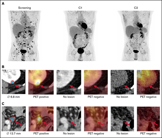 Whole-body 18F-FDG-PET/CT in patient UPN010 with disseminated extramedullary AML after 2 allogeneic transplants. Maximum intensity projection (A) and transaxial CT and fused PET/CT images of 2 exemplary lesions at screening, after C1 and after C2: left kidney (B) and lower pelvic cavity (C).