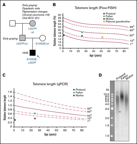 Family pedigree and telomere length measurements of patient with Hoyeraal-Hreidarsson syndrome. (A) Pedigree of family in which the proband has compound heterozygous variants in TERT. Amino acid changes resulting from the TERT variants are labeled in blue. Arrow and black shaded box indicate the proband with Hoyeraal-Hreidarsson syndrome; gray shading indicates those with mild DC features. (B) Relative telomere length (as a percentage of that of the control 4n cell line CCRF-CEM) according to age, measured by Flow-FISH. Lines represent the 1st, 10th, 50th, 90th, and 99th percentiles of telomere length of 240 healthy controls. (C) Relative telomere length according to age, measured by qPCR. Lines represent the 1st, 10th, 50th, 90th, and 99th percentiles of telomere length of 240 healthy controls. (D) Telomere length in the proband and his parents, measured by Southern blot analysis with a probe against telomeric DNA.