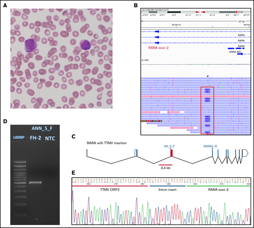 Morphology and TTMV integration structure of our case. (A) A peripheral blood (PB) smear from our patient, stained with Wright-Giemsa, showing circulating promyelocytic blasts with abundant azurophilic granules. (B) Alignment of unique sequencing reads from PB from our patient. Reads shown originated in RARA exon 3, where our CRISPR guide is designed to cut. Nine of 26 unique reads (35%) covering the region of interest showed an insertion of ∼2.4 kb (framed in red). (C) The RARA gene with the TTMV insertion between exons 2 and 3. Blocks represent exons, joined by lines showing introns. Empty blocks represent untranslated regions. The red bar (3.4 kb) is positioned to mark the whole size of the integrated TTMV; the red block is the fragment of the insertion that we could prove was transcribed in our patient. The locations of primers used in panels D and E are marked (AN_5_F and RARA3_R). (D) Agarose gel 2% stained with ethidium bromide showing the product of amplification of the patient’s PB RNA after reverse transcription and amplification with primers designed to target the insertion and RARA exon 3. First lane: 100-bp DNA ladder; second lane: our patient; third lane: the no-template control. The expected product size was 654 bp. The actual product size was closer to 600 bp, as an 84-bp fragment of the insertion was not in the transcribed product. (E) A Sanger sequencing chromatograph, showing the sequence of TTMV ORF2 adjoining RARA exon 3 with a small (14 bp) intron sequence preserved. The cartoon in panel C was generated with Worm-web (http://wormweb.org/exonintron).