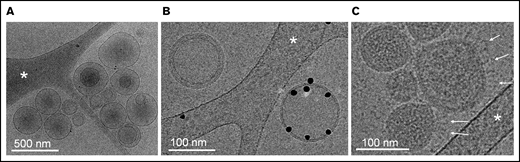 Cryo-electron microscopy of releasate from SARS-CoV-2–infected cells. (A) A set of EVs, ranging in size from 100 to 500 nm. Some EVs contain smaller EVs, as frequently observed in EV samples from various origins. (B) Two EVs side-by-side. One EV is specifically labeled with Anx5 gold particles, thus exposing the procoagulant lipid phosphatidylserine; the other one is unlabeled, thus does not expose phosphatidylserine. (C) A group of virus particles, characterized by their homogenous granularity and the presence of long protein protrusions (white arrows) corresponding most likely to spike proteins. (A-C) The white stars indicate thin threads of the carbon support film.