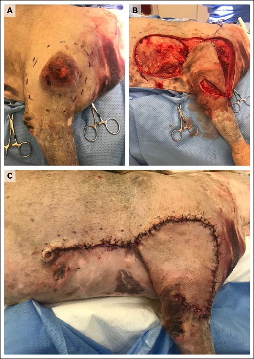 Wide surgical excision of a degranulating canine cutaneous MCT. (A) Preoperative photograph after initial surgical preparation and planning for wide excision. (B) Intraoperative photograph after wide resection of the tumor and elevation of a subdermal plexus skin fold flap. (C) Postoperative photograph revealing skin closure using a subdermal plexus flap. Images provided by Maureen Griffin and Ingrid Balsa.