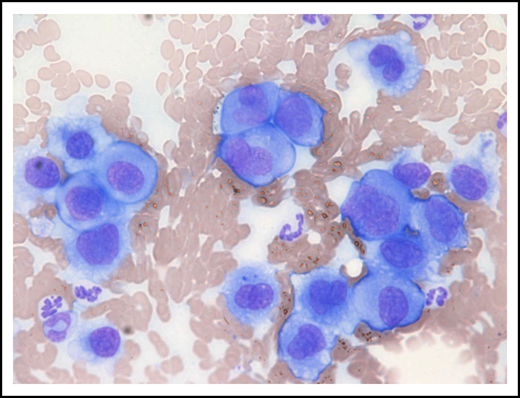 Metastatic gastric EMP in a 10-year-old female neutered cross-breed dog. Cytologic smear of fine-needle aspirate taken from a mesenteric lymph node revealing a pleomorphic population of malignant round cells with erythrocytes and neutrophils noted in the background (modified Wright-Giemsa stain; ×40 objective). Reprinted with permission.75