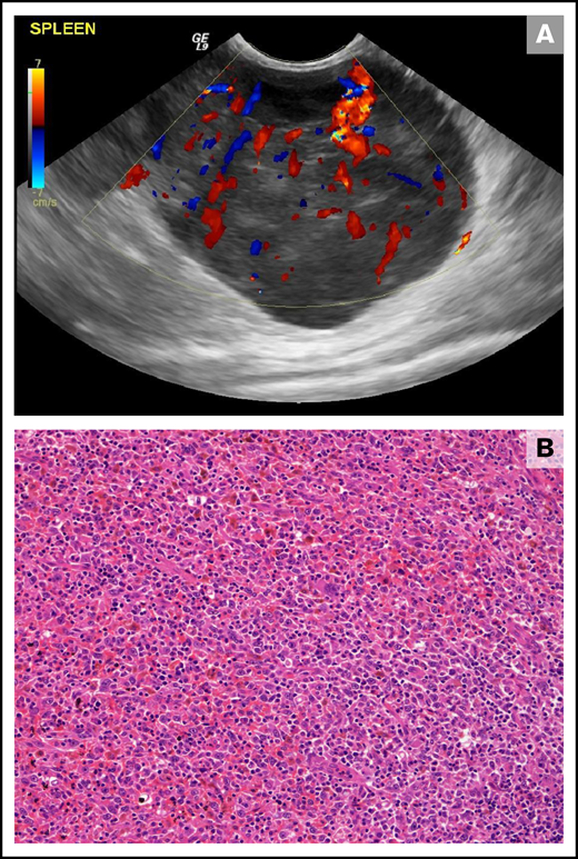 Splenic HS in a 10-year-old female neutered cross-breed dog. (A) Ultrasonographic still of a large (maximum diameter, 59 mm) well-vascularized (as demonstrated by Doppler color flow) mass lesion of mixed echogenicity within the tail of the spleen. (B) Histopathology of the splenic mass revealed a poorly encapsulated neoplasm showing both round and spindle morphologies of large tumor cells forming sheets and streams. Diagnosis of HS was confirmed using immunohistochemical stains (not shown; hematoxylin and eosin stain; ×20 objective).