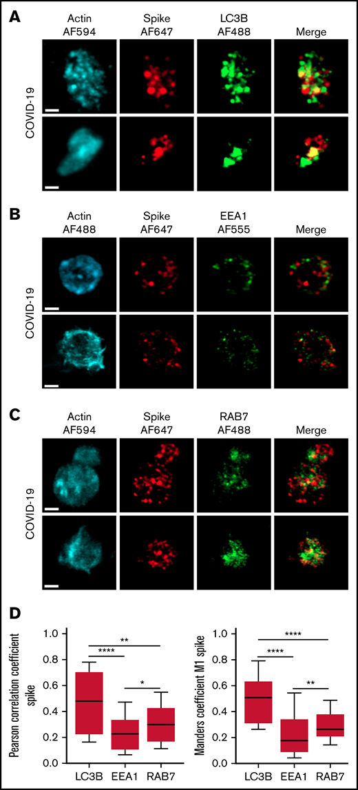 Localization of Spike protein in platelets from patients with severe COVID-19. The intraplatelet localization of Spike protein was investigated by immunofluorescence and super-resolution confocal microscopy with the Airyscan module using a specific anti-Spike antibody. Its colocalization with LC3B, a marker of autophagosomes (A), EEA1, a marker of early endosomes (B), and Rab7, a marker of late endosomes (C), was analyzed. Representative images from 5 different patients with severe COVID-19 are shown (bar represents 1 µm). Quantification was performed from the analysis of 30 to 40 platelets from each of the 5 patients with severe COVID-19 analyzed. Pearson’s correlation coefficient and Manders’ coefficient calculations are shown (D). *P < .05; **P < .01; ****P < .0001 according to the nonparametric Mann-Whitney test.