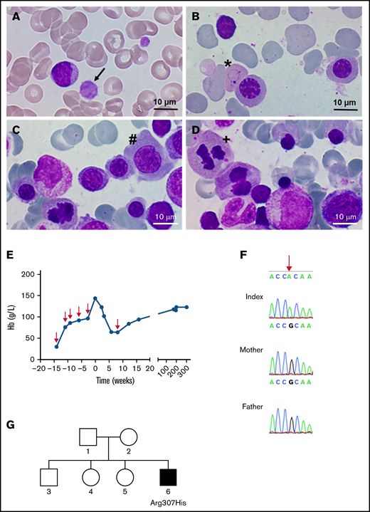 Identification of a GATA1 mutation causing severe fetal anemia. (A) The proband’s blood smear contains macrothrombocytes (black arrow). (B-D) Representative bone marrow smears show Cabot rings (B; ∗), megaloblasts (C; #), and mitosis (D; +), indicative of megaloblastic anemia. Smears were stained with May-Grünwald and photographed with a Nikon Eclipse E600 microscope equipped with a 100×/0.30 numerical aperture oil-immersion lens and a ProgRes SpeedXT core 5 camera, using Gryphax software (version 2.0). (E) Hemoglobin levels over time; red arrows indicate the time points of red blood cell transfusions. (F) DNA from the affected boy and the unaffected mother and father; the base mutation is indicated by the red arrow. (G) Pedigree of the family; the filled square represents the hemizygous male.