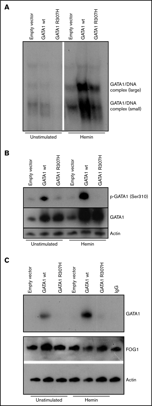 Biochemical characterization of mutant GATA1R307H. K562 cells were transfected with wild-type and mutated (c.920G>A) GATA1 cDNA constructs and stimulated for 3 days with 0.05 mM bovine hemin. (A) Nuclear extracts of wild-type and GATA1R307H-transfected cells were incubated with a 32P-labeled, double-stranded oligonucleotide probe (5′-CAC TTG ATA ACA GAA AGT GAT AAC TCT-3′). EMSA shows reduced DNA binding of GATA1R307H. (B) Immunoblot analysis of total and phosphorylated GATA1 was performed. Phosphorylation of Ser310 was totally absent in GATAR307H. (C) Immunoprecipitation of lysates with FOG1 antibody followed by western blot of GATA1. Input control of actin and FOG1 is shown. GATA1R307H showed reduced FOG1 affinity.