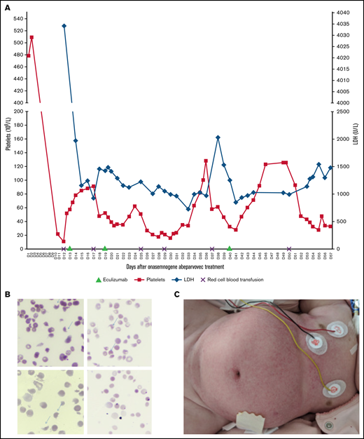 Clinico-biological characteristics of TMA. (A) Trends in platelet and LDH levels during hospitalization. Eculizumab was administrated at days 13, 19, and 40 after onasemnogene abeparvovec infusion. (B) Peripheral smear shows 6% schistocytes (arrows) at D12 (original magnification, ×50). (C) TMA diffuse skin damage.
