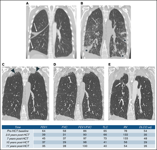 Serial thoracic CT of a patient with restrictive PcGVHD. (A) Baseline, with small pleural effusion (arrow). (B) At 3.5 years after HCT, admitted for hypoxia. CT scan shows normal lung apices and patchy foci of consolidation within the mid- to lower lungs (stars). (C-D) At 7 years after HCT. (C) Routine CT scan and (D) high-resolution CT scan images show apical pleural thickening (arrowhead) and subpleural consolidation and reticulation (arrow) that are associated with upper lobe traction bronchiectasis and volume loss. (E) At 10 years after HCT. CT scan shows progressive upper lobe volume loss, pleural thickening, and subpleural fibrotic consolidation. Upper lobe traction bronchiectasis (arrow) has also progressed.