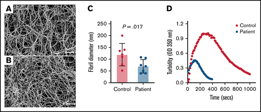 Fibrinogen Villeurbanne II forms abnormal-appearing polymer. Shown are SEM micrographs taken at the same magnification of fibrin clots produced from a 1.77-mg/mL fibrinogen solution purified from plasma obtained from a healthy donor (A) and the patient (B). Size bars, 20 μm. The patient’s fibrin clot was poorly formed, consisting of long, thin fibers with little bundling and irregularly spaced branch points. (C) Quantitative analyses of a 40-μm × 40-μm section of the micrograph show that the patient’s fibrils are significantly thinner than the control. The data represent the mean and SEM. The P value was generated using a Mann-Whitney U test. (D) Shown are the results of a turbidimetric fibrinolytic assay performed using the patient’s and control (normal) plasma. OD, optical density.