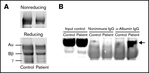 Fibrinogen Villeurbanne II forms aggregates with albumin in plasma. (A) The patient’s fibrinogen and fibrinogen from a healthy control appeared similar when blotted under reducing and nonreducing conditions. (B) Western blot analyses of fibrinogen coimmunoprecipitation demonstrating an interaction between the patient’s fibrinogen and albumin (at 66 kDa; arrow) that was not observed in fibrinogen from a healthy control, suggesting that the mutant fibrinogen forms aggregates with albumin. IgG, immunoglobulin G.