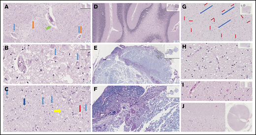 Severe histologic sequelae in the CNS of patients with TA-TMA. Cerebral (A-B; original magnification ×8 (A), original magnification ×40 (B)) and cerebellar (C-D; original magnification x20.5 (C), original magnification ×2.5 (D)) white matter show extensive demyelination, with scattered macrophages (C, yellow arrow, original magnification ×20.5), though not to confluence and not an infarct microscopically or in vascular distribution. Many vessels are affected by chronic changes in other organs that are related to TA-TMA. (C) Capillaries with thickened rigid walls shown at low power, appearing “wire-like” with a ratio of wall to lumen to wall occasionally 1:1:1 (red arrow) are present. (A-C) Capillary basement membrane layering and splitting and pericapillary clearing are also seen (light blue arrows and most pronounced, dark blue arrow). A range of capillaries and small arteries show similar features. Pigment is seen in small capillaries (A, orange arrows) and macrophages are present in the periarteriolar stroma (A, green arrow). (E-F; original magnification ×1.8 (E), original magnification ×8.5 (F)) Loss of myelination is readily evident on Luxol fast blue stain with periodic acid–Schiff highlighting vascular features. (G-J) These findings were compared with the histology in a patient without TA-TMA. There were normal delicate capillaries (red arrows) and tracks (blue arrows), as well as preserved parenchyma in cerebellar (G-H; original magnification x13 (G), original magnification ×40 (H)) and cerebral white (I, original magnification ×40) matter and spinal cord (J, interface of white and gray matter, original magnification ×14/×0.4).