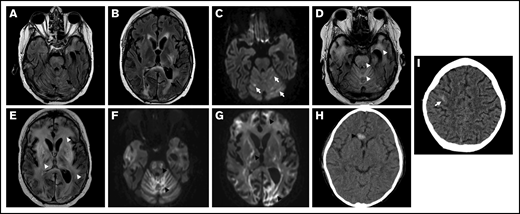 CNS radiographic abnormalities in TA-TMA. An 18-year-old man (patient 1 in Table 1) experienced progressive neurologic decline after HCT and underwent magnetic resonance imaging (A-G) on day 124 after HCT. He was diagnosed with TA-TMA on day 39. (A-B) Axial fluid-attenuated inversion recovery (FLAIR) images demonstrate multifocal areas of signal abnormality (black arrows) in the cerebellum, brainstem, periventricular white matter, and posterior limb of the left internal capsule and adjacent basal ganglia. (C) A T2-trace diffusion–weighted image demonstrates corresponding diffusion restriction predominantly within areas of signal in the cerebellum (white arrows). (D-E) Progressive hyperintense signal abnormality on FLAIR throughout the cerebellum, brainstem, cerebral white matter, and deep gray nuclei (white arrowheads). (F-G) Diffusion-weighted imaging demonstrates corresponding progressive diffusion restriction (black arrowheads). A 4-year-old patient with neuroblastoma (patient 3 in Table 1) experienced altered mental status on day 10 after autologous HCT and underwent a head CT (H-I). TA-TMA was diagnosed on the same day. Axial computed tomographic images demonstrate a new, ovoid, high-attenuation hemorrhage in the genu of the corpus callosum (arrowhead), as well as a more subtle hemorrhage along the cortical surface of the posterior right frontal lobe (arrow).