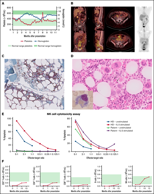 Clinical and immunological findings. (A) Absolute platelet numbers and hemoglobin levels over time (from acute phase until the present time). (B) FDG-PET showing hepatosplenomegaly and extensive mesenteric fat infiltration. (C) CD4/CD8 double-stained omental biopsy specimen (original magnification ×40), with CD4+ lymphocytes stained brown and CD8+ lymphocytes stained red, infiltrating between the mature adipocytes. (D) Hematoxylin and eosin–stained bone marrow biopsy specimen (original magnification ×40), showing trilineage hematopoiesis and scattered histiocytic cells with packed erythrocytes in the cytoplasm. Inset in the left bottom corner is Giemsa-stained bone marrow aspirate (original magnification ×100), highlighting a hemophagocytic histiocyte. (E) NK-cell function before (left) and after (right) treatment. (F) Absolute B-cell, T-cell, and NK-cell counts over time (from acute phase until the present time). Green shading indicates age-dependent normal values.