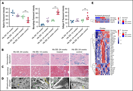 (A) Fluorescence intensity of nephrin retained in the glomerulus, interstitial macrophage infiltration (defined by F4/F80-positive cells), and collagen IV deposition in the transgenic sickle and Hb AA mice. Representative images at 200× of hemosiderin deposition by Prussian blue stain (B) and interstitial fibrosis by Masson trichrome stain (C) in the transgenic sickle and Hb AA mice. (D) Representative images of ultrastructural changes by transmission electron microscopy. Yellow arrows represent foot process effacement, green arrows represent segmental basement membrane reduplication and subendothelial electron-lucent widening, and orange asterisks represent segmental mesangial interposition with new basement membrane formation. (E) Heat map of genes differentially expressed in isolated glomeruli and kidney cortices of GBT1118-treated sickle, control sickle, and Hb AA mice (false discovery rate <0.05). **P < .01 for differences between the GBT1118-treated vs control sickle mice.