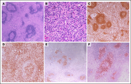 PNMZL with features reminiscent of PTFL. (A) The lymph node shows scattered large follicles with intact mantle cuffs. The germinal centers are irregular and fragmented, resembling progressive transformation of germinal centers. However, the interfollicular region is markedly expanded. (B) The atypical interfollicular infiltrate is polymorphous and is composed of small- to medium-sized lymphoid cells, some displaying plasmacytoid features. Occasional eosinophils and histiocytes are present. (C) The CD20 stain highlights increased interfollicular B cells. (D) CD3 shows admixed T cells, some of which localize to the follicle centers. BCL6 highlights the germinal centers (E), some of which show an irregular serpiginous configuration also seen with the stain for CD10 (F).