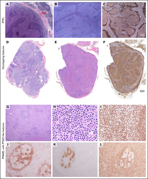 Morphological characteristics of PTFL, PNMZL and cases with overlapping features. (A-B) Two examples of typical PTFL with expanded, serpiginous germinal centers with a starry-sky pattern and attenuated mantle zones. Note in panel A, a rim of normal lymph node at the upper edge of the biopsy specimen. (C) IgD stain highlights the attenuated mantle zone. (D) PNMZL with overlapping features with PTFL, Case 28. The lymph node shows large, irregular germinal centers with attenuated marginal zones together with expanded interfollicular areas. (E) Case 19. The lymph node reveals an infiltrate with nodular pattern with recognizable hyperplastic germinal centers and expanded mantle zones with marginal differentiation. (F) IgD stain shows the extension of the mantle zone B cells into the germinal centers, which display fragmentation, resembling progressively transformed germinal centers (PTGC). (G-L) PNMZL with PTGC-like features.Case 40. (G) Lymph node with residual reactive follicles but the interfollicular region is markedly expanded. (H) The cellular infiltrate is polymorphous with occasional plasma cells and immunoblasts. (I) A stain for CD20 shows a predominance of B cells surrounding a residual follicle. (J) IgD stain shows the intact mantle cuff. The germinal center exhibits some fragmentation reminiscent of PTGC. (K) The residual germinal centers are positive for CD10 and negative in the atypical cells. (L) BCL2 is negative in germinal centers but positive in interfollicular cells.