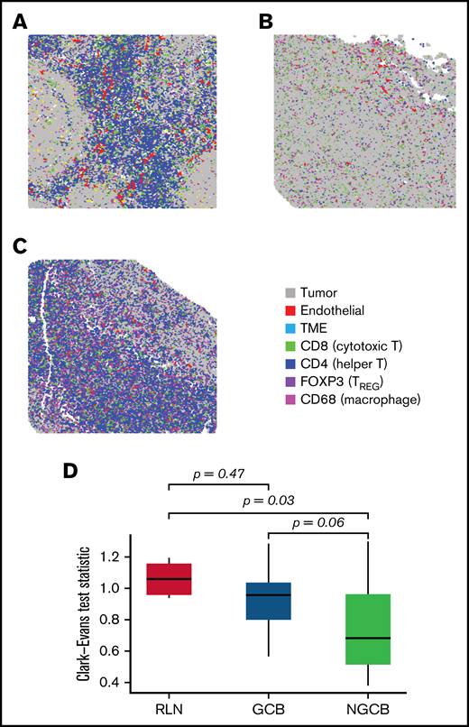 Spatial clustering reveals differences in tumor topology that associate with COO and TME abundance. (A-C) The spatial distribution corresponding to B cells were examined in reactive lymph nodes, and in NGCB/GCB tumor environments (A, B, and C, respectively). By visual examination, heterogeneous spatial arrangements of tumor differed by COO classification (GCB/NGCB). The Clark-Evans aggregation index quantifies the level of spatial regularity (index > 1), or clustering (index < 1), and was applied to the B-cell topology classes in reactive lymph node (RLN) and DLBCL (GCB and NGCB). (D) The Clark-Evans index was standardized and compared against the RLN. This indicated the B-cell topology classes in non-GCB cases were significantly more irregularly clustered compared with RLN (Tukey P = .03), whereas GCB had spatial regularity similar to RLN (Tukey P = .47). There was marginal difference comparing GCB with NGCB (Tukey P = .058). This indicates that the spatial distribution of the malignant B cells in GCB tumors more closely resembles the B-cell architecture of normal follicles, whereas malignant B cells in non-GCB tumors were more dispersed. A further multivariate linear model identified that NGCB tumors were significantly more clustered compared with GCB cases after adjusting for each Chapuy molecular signature (C1-C5), and IPI (P = .034, estimate = −0.1974; 95% CI, -0.374 to -0.012). Representative ROIs of highest spatially organized RLN (left, Clark-Evans Index = 1.16), most organized GCB case (middle, Clark-Evans Index = 1.29), and least spatially organized in NGCB (right, Clark-Evans Index = 0.54).