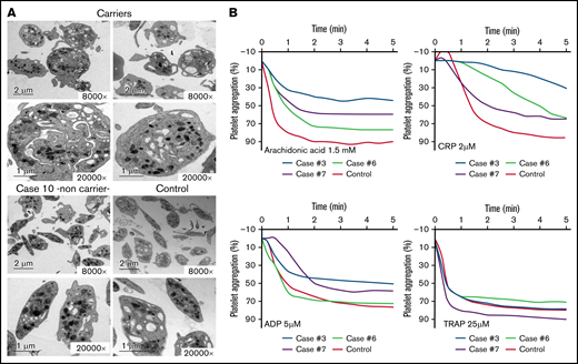 Electron microscopy and aggregation studies in carriers and noncarriers of the Src p.E527K variant. (A) Electron microscopy of platelets from 2 carriers of the Src p.E527K variant (patients 3 and 7), a noncarrier family member (patient 10), and a healthy control. Magnification for each image is shown (8000-20 000×). Images were acquired in a JEOL transmission electron microscope. (B) Platelet-rich plasma aggregation profiles in response to the indicated agonists from patients 3, 6, 7, and a control subject. CRP, collagen-related peptide; TRAP, thrombin receptor activating peptide (PAR-1).