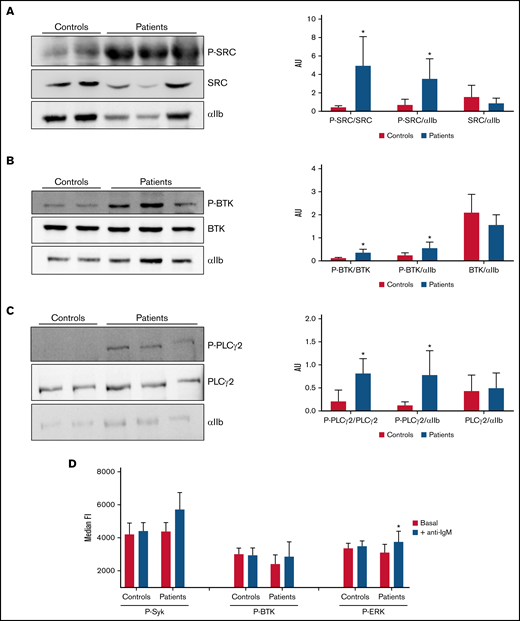 Analysis of tyrosine-phosphorylated proteins in platelets and lymphocytes. (A-C) Evaluation of resting platelet lysates was done in members of the SRC-RT pedigree carrying the Src p.E527K variant (patients 3, 6, and 7), in parallel with those of 2 controls. αIIb was used as loading control. *P ≤ .05 between patients and controls. (A) Representative image of immunoblotting experiments of SRC and phospho-SRC (P-SRC), and densitometric analysis of the bands obtained with 2 separate experiments (mean ± standard deviation). (B) Representative image of immunoblotting experiments of BTK and phospho-BTK (P-BTK), and densitometric analysis of the bands obtained with 2 separate experiments (mean ± standard deviation). (C) Representative image of immunoblotting experiments of PLCγ2 and phospho-PLCγ2 (P- PLCγ2), and densitometric analysis of the bands obtained with 2 separate experiments (mean ± standard deviation). (D) Flow cytometric evaluation of SRC downstream targets in B (CD19+) lymphocytes. Phosphorylation of tyrosine kinases were analyzed in unstimulated cells (white bars) or after stimulation with anti-IgM (black bars) in Src p.E527K carriers (patients 3 and 9) and control lymphocytes (n = 2) by flow cytometry. Data are representative of 2 individual experiments. Results reflect mean ± standard deviation values. AU, arbitrary units; FI, fluorescence intensity. *P ≤ .05 between stimulated and unstimulated samples.