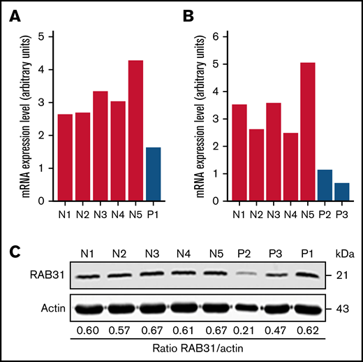 RAB31 expression in platelets from RUNX1-haplodeficient patients (P) and normal control subjects (N). Platelet RAB31 messenger RNA (mRNA) levels by quantitative PCR in the index patient (P1) (A) or in 2 siblings (P2 and P3) from an unrelated family (B) with a RUNX1 mutation compared with 5 normal subjects (N1-N5). mRNA levels normalized to glyceraldehyde-3-phosphate dehydrogenase expression. (C) Platelet RAB31 by immunoblotting in 3 patients (P1-P3) and 5 healthy subjects (N1-N5). Protein expressions are shown in the ratio of RAB31 to actin.