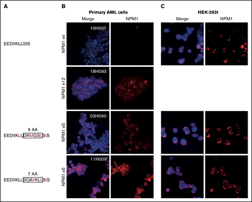 Aberrant cytoplasmic localization of NPM1e5 mutations. (A) NPM1 exon 5 protein sequences. Rectangles indicate amino acids insertions, and predicted NES are indicated in red. (B) NPM1 localization in primary NPM1 wild-type (WT) and NPM1 mutated samples. (C) Overexpression of WT and mutated patient-specific sequences in HEK-293t cell lines. Images were acquired on a Leica DMi8 microscope using 100× magnification with oil immersion. Brightness and contrast were adjusted with ImageJ.