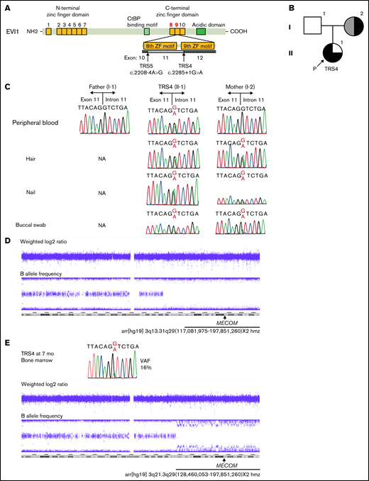 Analysis of MECOM in TRS4 and her family. (A) Graphical representation of the EVI1 protein and its major functional domains. EVI1 harbors 7 ZF motifs in the N-terminal ZF domain and 3 ZF motifs in the C-terminal ZF domain. Arrows indicate the exon boundaries affected by the variants in this study. (B) Pedigree of family 1. Black on the left represents pancytopenia, gray on the left represents mild leukocytopenia and thrombocytopenia, black on the upper right represents radioulnar synostosis, and black on the lower right represents clubfoot. P indicates the proband (TRS4). (C) Mutation analysis of TRS4 and her family. The genomic DNA sources are listed on the left. (D) The results of SNP array using the DNA from leukocytes in the peripheral blood of the mother of TRS4. The weighted log 2 ratio revealed neutral copy number, and the B allele frequency showed the loss of heterozygosity from 3q13.31 to 3q29. (E) The results of Sanger sequencing and SNP array obtained using the DNA from the bone marrow of TRS4 at 7 months of age. The mutant A peak was smaller than the G (wild-type) peak in the electropherogram. SNP array showed copy-neutral loss of heterozygosity from 3q21 to 3q29. NA, not available; SNP, single nucleotide polymorphism; VAF, variant allele frequency determined by WES.
