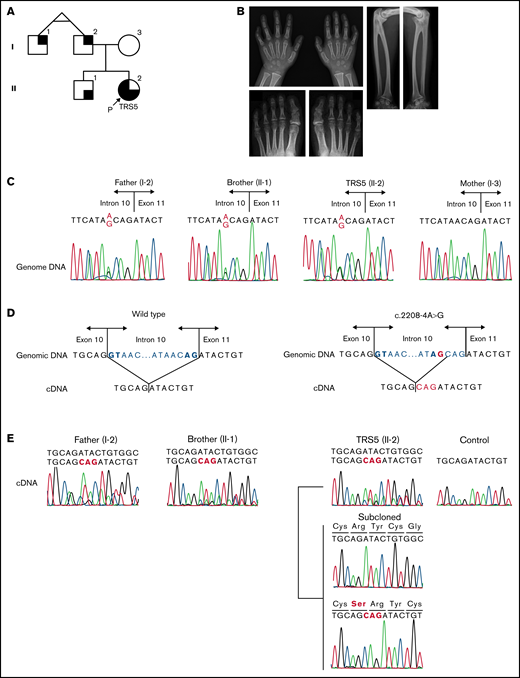 Analysis of MECOM in TRS5 and her family. (A) Pedigree of family 2. Black on the left represents pancytopenia, black on the upper right represents radioulnar synostosis, and black on the lower right represents clinodactyly of the fifth finger of hands. P indicates the proband (TRS5). (B) Radiographs of the individuals with c.2208-4A>G variants. Left, bilateral clinodactyly of the fifth fingers of the brother of TRS5 (II-1). Lower left, PIP joint fusion of bilateral second toes were suspected. Fusions of the DIP joint of the fourth and fifth toes on the left foot and third, fourth, and fifth toes on the right foot of the father of TRS5 (I-2). The incidence of DIP fusion in the Japanese population is 72.5% in the fifth toe, 11.9% in the fourth toe, and 0.8% in the third toe.17 Right, bilateral radioulnar synostosis in the father of TRS5 (I-2). (C) The c.2208-4A>G variant in MECOM in TRS5 and her family. The variant was identified in TRS5 as well as her brother and father. (D) A schema showing the splicing of wild-type (left) and mutant (right) RNA. Bold letters show GT-AG consensus nucleotides. (E) cDNA analysis revealed the presence of the in-frame insertion in TRS5 as well as her father and brother. PCR primer set 2 was used for TRS5 and her brother, and PCR primer set 3 was used for her father. cDNA, complementary DNA; DIP, distal interphalangeal; PCR, polymerase chain reaction; PIP, proximal interphalangeal.