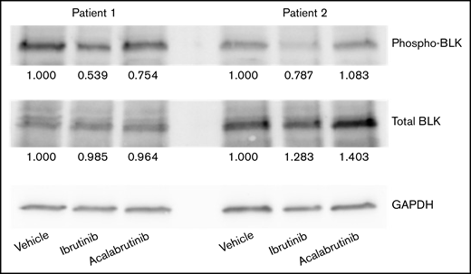 Ibrutinib inhibits BLK phosphorylation. CLL cells were treated with 1 μM ibrutinib or acalabrutinib for 1 hour before lysing, and BLK, phosphorylated BLK, and GAPDH levels were measured by western blotting. Numbers below each band indicate fold change vs the vehicle control, normalized by GAPDH. Figure shows 2 representative patient samples of 3 studied.