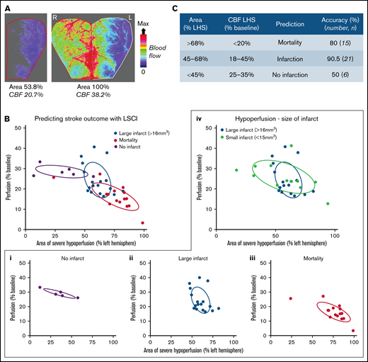 Stroke outcome at 24 hours is predicted by cortical perfusion measurements. C57BL/6 mice were subjected to the iCAT stroke model (60 minutes’ ischemia). (A) Representative flux image of the ipsilateral (L) and contralateral (R) cerebral cortex of a C57BL/6 mouse at 90 minutes’ post–stroke onset, in which the left inset depicts the area of ipsilateral hemisphere with severe hypoperfusion, defined as threshold <250 flux units, as quantified using moorReview 5.0 software. (B) Scatter plots represent the calculated area of severe hypoperfusion (as assessed in panel A) correlated with the overall degree of hypoperfusion within the same region, for each individual mouse. Data were analyzed by using XLSTAT (Addinsoft, Paris, France) to highlight any correlation between the level of hypoperfusion and stroke outcomes, where mice were grouped according to their outcome at 24 hours, including no infarct (no TTC-visible infarction) (i), large infarct (infarct visible on TTC > 16 mm3) (ii), and small infarct (infarct visible on TTC < 15 mm3) or mortality (iii), where an individual mouse was deceased before end point. (iv) Severe and moderate hypoperfusion were classified as LSCI flux <21% of baseline and LSCI flux between 21% and 37% of baseline, respectively. (C) Tabulated summary depicting area of hypoperfusion and correlated predictive outcome, based on the analysis presented in panel B. Experiments were conducted at ambient temperature <21°C (Site 1).