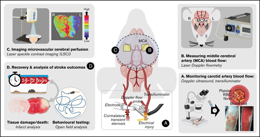 Schematic overview of the iCAT stroke model. (A) The iCAT model incorporates thrombotic occlusion of the CCA induced by electrolytic injury to allow for real-time monitoring of occlusion and recanalization events. (B) After thrombotic occlusion of the carotid artery, transient stenosis of the contralateral carotid artery induces ipsilateral cerebral hypoperfusion sufficient to induce infarction (<25% baseline flow), measurable with LDF over the MCA territory. Cerebral perfusion analysis with LSCI at 90 minutes’ post–stroke onset is predictive of 24-hour outcome (C), including behavioral deficit, infarct progression, and mortality (D). Elements of this image were created with BioRender.com and exported under a paid subscription. RBC, red blood cell.
