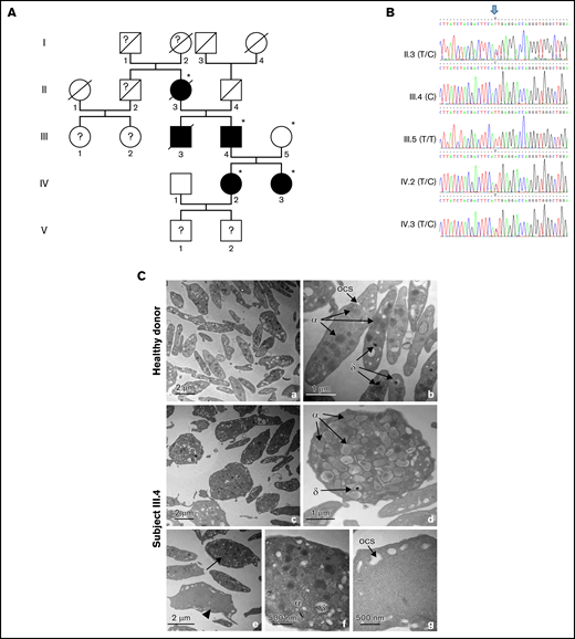 Pedigree, validation of the WAS variant, and electron microscopy of platelets. (A) Pedigree of the family. Generations are designated by Roman and subjects by Arabic numerals. Squares and circles represent male and female subjects, respectively. Solid (black) symbols indicate patients, while open (white) symbols indicate unaffected family members. Individuals labeled with a star (II.3, III.4, III.5, IV.2, and IV.3) were subjected to exome sequencing. (B) Sanger sequencing and intrafamilial segregation pattern of the c.881T>C WAS variant. The genotypes of the different family members are indicated between parentheses. The arrow indicates the position of the variant. The reference sequences are presented in color. The alternative alleles observed in each individual are shown above (Y: C or T; dots: identical to reference sequence). (C) Transmission electron microscopy images showing the ultrastructure of platelets from a healthy donor (a,b) and subject III.4 (c-g). Wide-field electron micrographs of platelets show the increased platelet size and heterogeneous content in subject III.4 (c) compared with control platelets (a). The arrow points to a platelet with high content and the arrowhead to a platelet with low content (e). Higher magnifications are shown to illustrate the compact appearance (d,f) and gray appearance (g) of the platelets. α, α granules; δ, dense granules; ocs, open canalicular system.