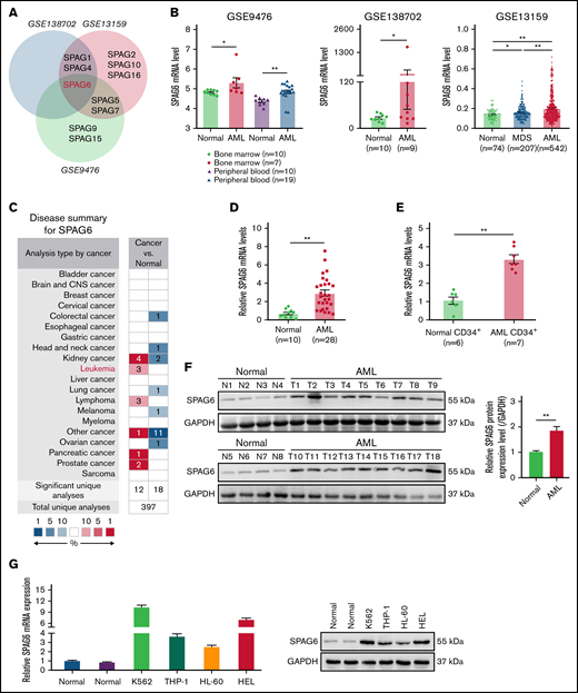 Upregulation of SPAG6 is a frequent event in AML patients and indicates a poor prognosis in human AML. (A) The public data on AML were obtained from GEO (Gene Expression Omnibus) databases, and the mRNA expression levels of SPAG6 in AML and control samples were statistically analyzed. (B) The mRNA level of SPAG6 in 3 independent datasets GSE9476, GSE138702, and GSE13159. (C) SPAG6 expression in tumor and normal tissues was analyzed on the website https://www.oncomine.org/. (D) Real-time polymerase chain reaction analysis of SPAG6 mRNA expression in AML patients (n = 28) and control samples (n = 10). (E) SPAG6 expression in CD34+ leukemia stem cells from AML patients (n = 7) and control samples (n = 6). (F) Western blot analysis of SPAG6 protein expression in AML patients (n = 18) and control samples (n = 8). (G) The mRNA and protein level of SPAG6 in normal hematopoietic cells and K562, THP-1, HL-60, and HEL cells. (H) Overall survival analyses between patients with high or low SPAG6 expression in TCGA and GSE37642 dataset. (I) SPAG6 expression from AML patients (n = 35) with various cytogenetic aberrations. (J) The correlation between SPAG6 expression and AML CALGB cytogenetics risk category in TCGA database. (K) SPAG6 expression from AML patients with various cytogenetic aberrations (GSE13159). (L) SPAG6 expression from AML patients with different risk status in Vizome-ELN2017. *P < .05; **P < .01. LCSs, leukemia stem cells.