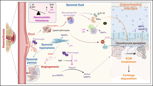 Potential role of proteases in HA. During hemarthroses, blood comes into contact with joint structures. The introduction of blood causes an influx of iron (Fe), interacting with hydrogen peroxide (H2O2) produced by chondrocytes, resulting in hydroxyl radicals (OH), causing chondrocyte apoptosis. Type A synoviocytes incorporate hemosiderin and produce proinflammatory cytokines IL-1α, IL-6, and TNF-α, leading to an intraarticular cytokine storm that worsens cartilage and bone damage. These cytokines promote the recruitment and activation of monocytes and macrophages, prompting of production of MMPs and plasminogen activators (uPA and tPA). Synovial tissue proliferation occurs under inflammatory conditions to produce pro-MMPs and upregulate uPA, while angiogenesis occurs under the influence of VEGF, leading to the formation of synovial pannus. There is a hemostatic imbalance in the synovial fluid of patients with hemophilia. It is characterized by high levels of thrombomodulin and impaired TAFI activation due to low TF levels. Lack of TAFI activation, in turn, enhances uPA-mediated fibrinolysis and consequent clot instability leading to premature clot lysis. The influx of plasminogen occurs with blood and is converted to plasmin by uPA. Plasmin activates MMPs to degrade cartilage and bone. ADAMTS, a disintegrin and metalloprotease with thrombospondin type 1 motifs; MMP: matrix metalloprotease; TF, tissue factor; TFPI, thrombin activatable fibrinolysis inhibitor; TM, thrombomodulin. Created with Biorender.com.