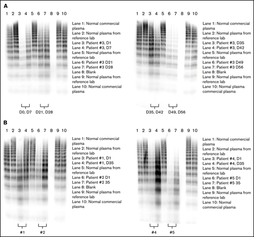 Rondoraptivon pegol effects on VWF multimers. Rondoraptivon pegol increases intermediate and HMW multimers of VWF. Three milligrams of rondoraptivon pegol was injected subcutaneously on days 1, 4, and 7, followed by up-titration to 6 to 9 mg at weekly intervals. (A) Time course in patient 3. (B) Comparison between baseline and day 35 (1 week after the last rondoraptivon pegol dose) for the other patients. Patients 1 and 4 were on substitution therapy with recombinant VWF.