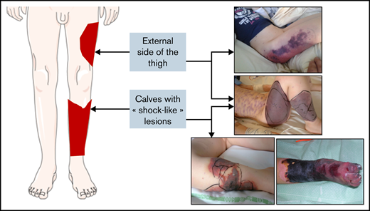 Schematic depiction of typical lower limb lesions observed in many cases, with corresponding photographs of affected areas.