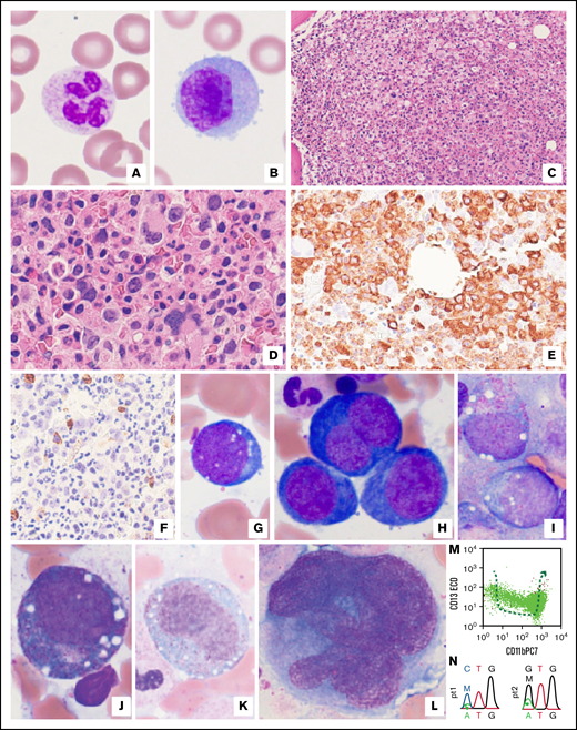 Examination of peripheral blood and bone marrow biopsy specimens, as well as ancillary studies for both VEXAS patients. (A-B) There were no cytoplasmic vacuoles or overt dysplastic changes in neutrophils (A) or monocytes (B) in peripheral blood (representative pictures from patient 1) Original magnification ×1000. (C-E) Markedly hypercellular bone marrow (C) showed extensive granulocytic hyperplasia with complete maturation (D). (E) This effect is also illustrated by MPO immunostaining in a representative image from patient 2. Original magnifications ×200 (C), ×400 (D-E). (F) By immunohistochemistry, there was no significant increase in CD34+ blasts (3% to 4% of bone marrow elements). Original magnification ×400, a representative image from patient 2. (G-H) Characteristic vacuoles were found in erythroid precursors (pronormoblasts) (G), and profound megaloblastic changes were seen (H) in patient 1, although overt nuclear membrane irregularity was not appreciated. Original magnification ×1000. (I-K) Prominent vacuoles were also identified in myeloblasts (I), promyelocytes (J), and immature monocytes (K) in patient 2. Original magnification ×1000. (L) Frequent immature-appearing megakaryocytes showed an increased nuclear/cytoplasmic ratio, whereas typical dysplastic changes were not identified in patient 2. Original magnification ×1000. (M) By flow cytometry, granulocytes exhibited an abnormal maturation pattern illustrated by plots with CD13 vs CD11b in patient 2. (M) Dashed arrow indicates the normal granulocytic maturation pathways. (N) UBA1 mutations p.M41L and p.M41V were confirmed by Sanger sequencing in patients 1 and 2, respectively. Top codons, patients’ variants; bottom codons, reference codons. M, mutant; W, wild-type.