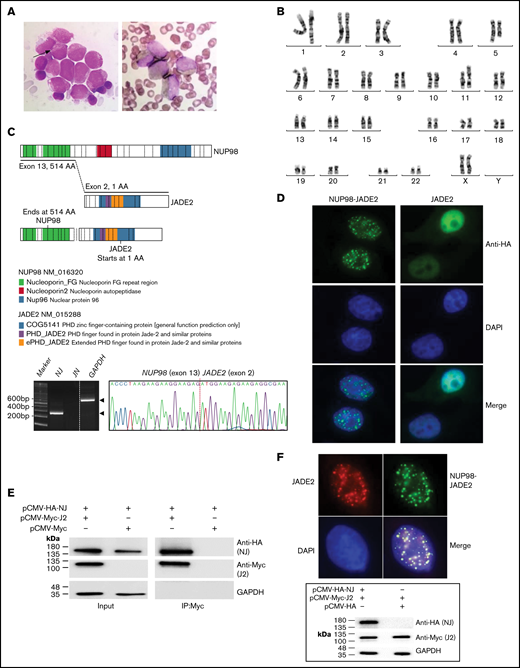 Identification of the NUP98-JADE2 fusion. (A) Left, May-Grünwald-Giemsa staining of leukemic blasts in the diagnostic bone marrow (BM). The blasts were medium to large size with fine nuclear chromatin and nucleoli showing hypergranular cytoplasm. Occasional cells with 1 to 2 Auer rods (arrow) were seen but no faggot cell was detected. Right, Sudan Black B-stained positive blasts. Original magnification ×1000. (B) A karyotype performed on the diagnostic BM revealed 46,XX,t(5;11)(q31;p15). (C) Upper, a schematic diagram showing NUP98, JADE2, and NUP98-JADE2 generated by ProteinPaint. The phenylalanine-glycine (FG)/glycine-leucine-phenylalanine-glycine (GLFG) repeats and Gle2-binding-sequence (GLEBS) domain in the amino-terminal portion of NUP98 are retained in the fusion protein. Lower, RT-PCR analysis of NUP98-JADE2 (NJ) and JADE2-NUP98 (JN) fusions in the diagnostic BM. Whole BM cells were used for the analysis. Amplification of GAPDH served as the control. Expected products are indicated by arrowheads. Sanger sequencing of the NJ PCR product is also shown. (D) Immunofluorescence analysis of NUP98-JADE2 and wild-type JADE2. HeLa cells were transfected with pCMV-HA-NUP98-JADE2 or pCMV-HA-JADE2, and the tagged proteins were detected as described in supplemental Methods. DAPI was used for nuclear staining. Original magnification ×1000. (E) Interaction between NUP98-JADE2 and wild-type JADE2. 293T cells were transfected with the indicated Myc- and HA-tagged expression vectors. Myc-tagged proteins were immunoprecipitated and samples were analyzed by immunoblotting for NUP98-JADE2 (NJ) and JADE2 (J2) detection. Similar results were obtained when HA-tagged proteins were immunoprecipitated before immunoblotting (data not shown). (F) Altered subcellular distribution of wild-type JADE2 in the presence of NUP98-JADE2. Upper, HeLa cells were cotransfected with both pCMV-HA-NUP98-JADE2 and pCMV-Myc-JADE2, and the tagged proteins were detected as mentioned previously. Original magnification ×1000. Lower, HeLa cells were transfected with the indicated Myc- and HA-tagged expression vectors. Protein lysates were analyzed by immunoblotting. No apparent change in JADE2 expression was noted when NUP98-JADE2 was coexpressed.